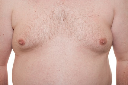 Gynäkomastie – Operation, Fettabsaugung, Behandlung der männlichen „Fettbrust“