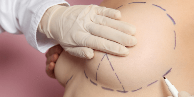 Bruststraffung – Welches Verfahren ist für wen geeignet?
