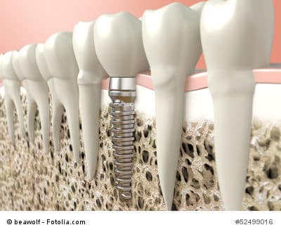 Was tun, wenn Zahnersatz notwendig ist? Zahnimplantate bieten Halt und kräftigen Biss