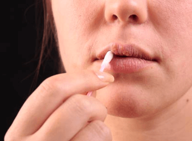 Herpes – die erfolgreichsten Hausmittel gegen Lippenbläschen
