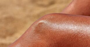Sonnenbrand