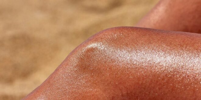 Sonnenbrand