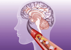 Thrombose gelangt zum Gehirn