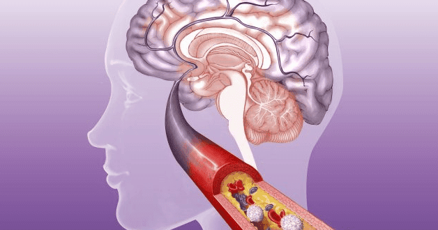 thrombose