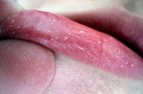 Trockene Lippen – mit einfach Mittel zu sanfter Lippenhaut